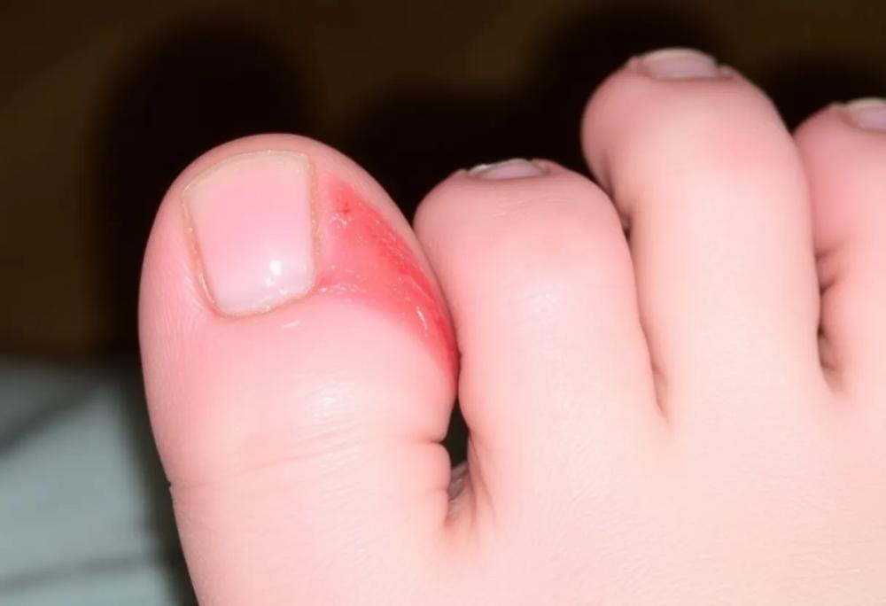 ingrown toenail-0a7a9de016124493872cd8a69bbf7d7b.jpg ingrown toenail