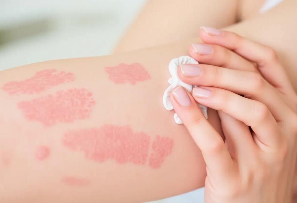 psoriasis treatment